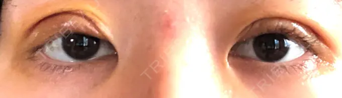 眼瞼下垂（切開） / 目元修正 札幌ル・トロワ ビューティクリニックVogue DAY 6 メイン用