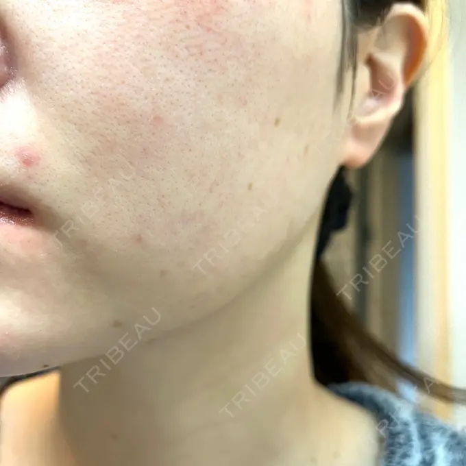 ダーマペン RAISE CLINIC 【レイズクリニック】 AFTER メイン用