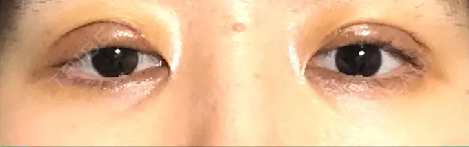 眼瞼下垂（切開） / 目元修正 札幌ル・トロワ ビューティクリニックVogue DAY 7 メイン用