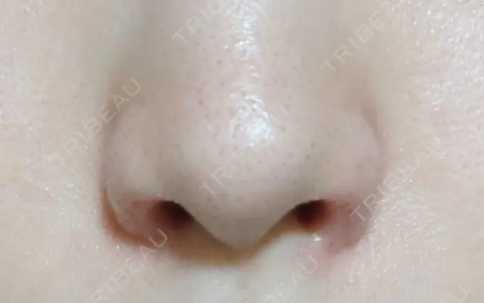 鼻孔縁挙上 シエルクリニック DAY 16 メイン用