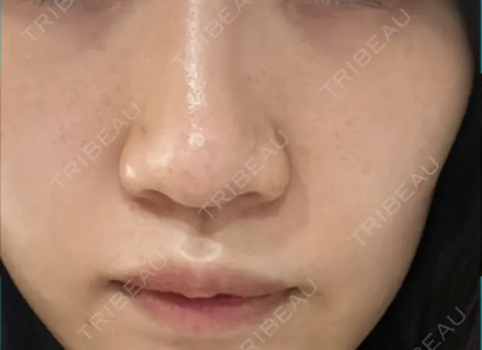 ピコレーザートーニング（美白・肝斑） ルラ美容クリニック 高田馬場院 AFTER メイン用