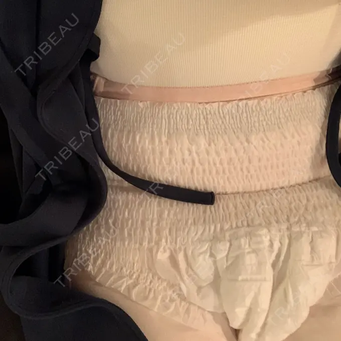 脂肪吸引（二の腕） / 脂肪吸引（お腹） / 脂肪吸引（腰） / その他（ボディ） WOM CLINIC GINZA （ワム クリニック ギンザ） DAY 1 メイン用