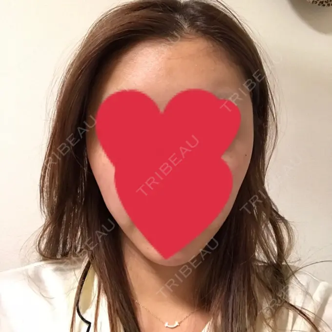 バッカルファット除去 / 脂肪吸引（顔） / 額を丸く / ヒアルロン酸注入（あご） / ボトックス（エラ・小顔） / ヒアルロン酸注入（額） エートップ美容整形外科 DAY 20 メイン用