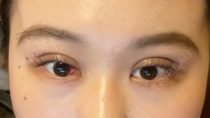 二重埋没 湘南美容クリニック 京都院 DAY 1 メイン用