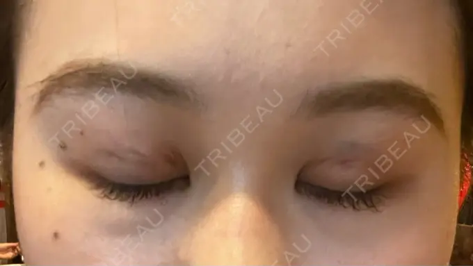 二重埋没 湘南美容クリニック 京都院 DAY 1 メイン用