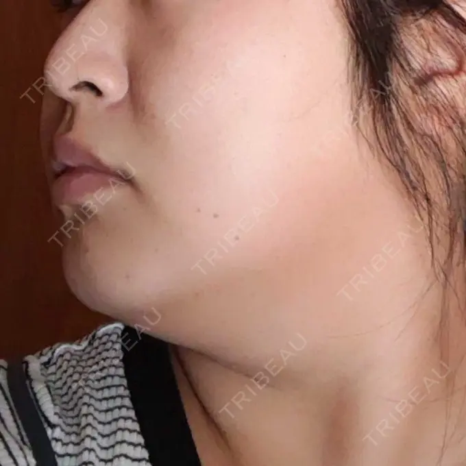 医療痩身（顔） 湘南美容クリニック 名古屋院 DAY 2 メイン用