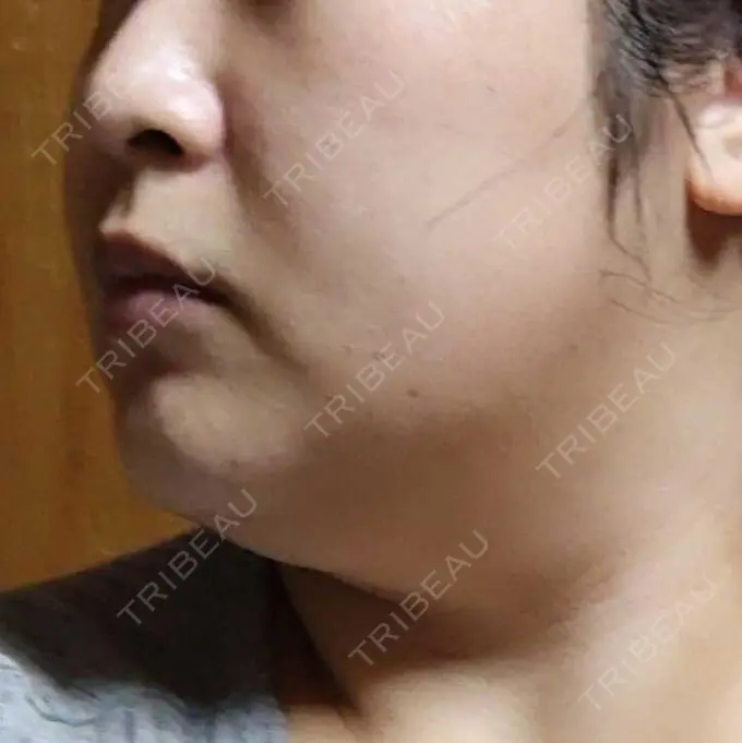 医療痩身（顔） 湘南美容クリニック 名古屋院 DAY 3 メイン用