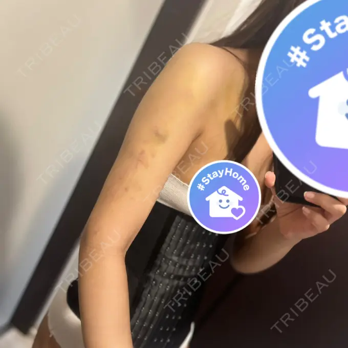 脂肪吸引（二の腕） / 脂肪吸引（お腹） / 脂肪吸引（腰） / その他（ボディ） WOM CLINIC GINZA （ワム クリニック ギンザ） DAY 4 メイン用