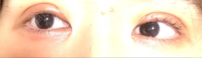 眼瞼下垂（切開） / 目元修正 札幌ル・トロワ ビューティクリニックVogue DAY 10 メイン用