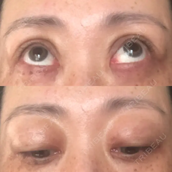 二重埋没 / 目元修正 新宿TAクリニック DAY 42 メイン用