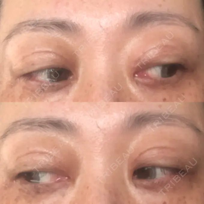 二重埋没 / 目元修正 新宿TAクリニック DAY 42 メイン用