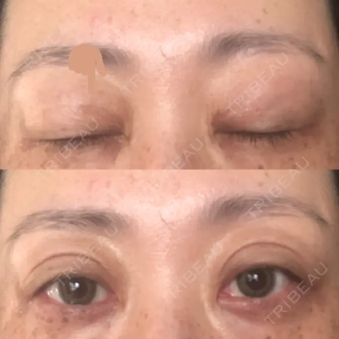 二重埋没 / 目元修正 新宿TAクリニック DAY 42 メイン用