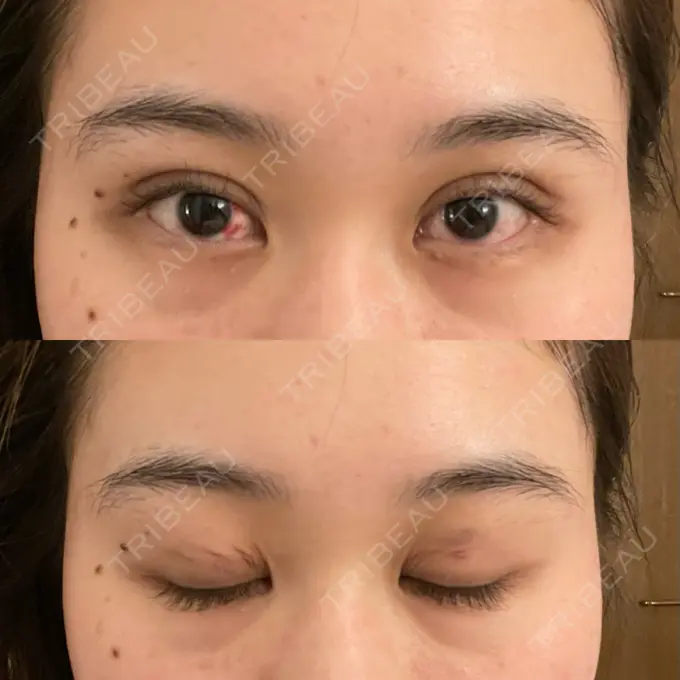 二重埋没 湘南美容クリニック 京都院 DAY 2 メイン用