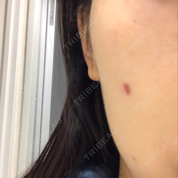 ほくろ・いぼ切除（肌） 吉祥寺アイビークリニック DAY 57 メイン用