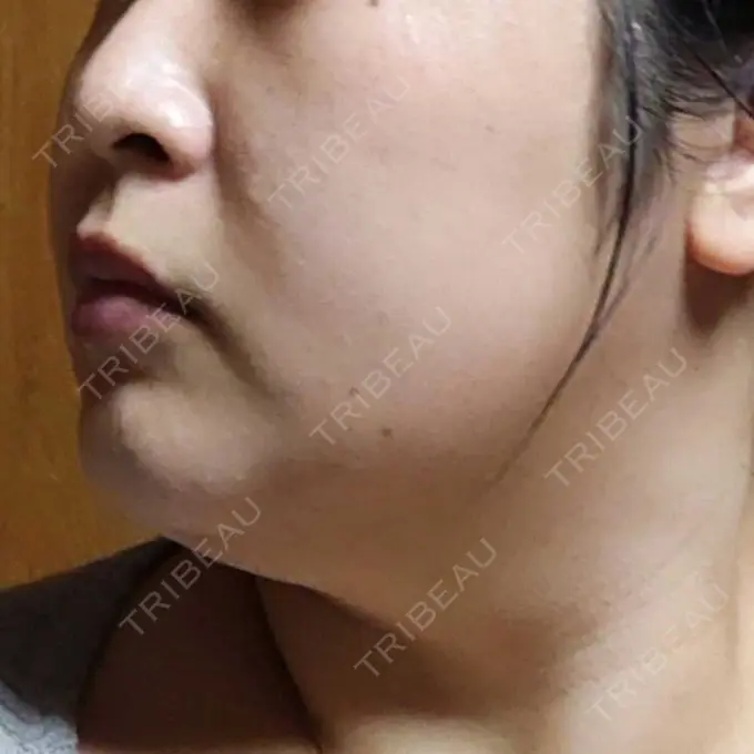 医療痩身（顔） 湘南美容クリニック 名古屋院 DAY 4 メイン用