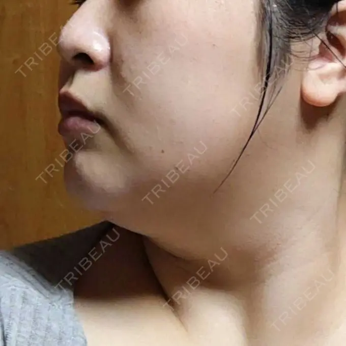 医療痩身（顔） 湘南美容クリニック 名古屋院 DAY 5 メイン用