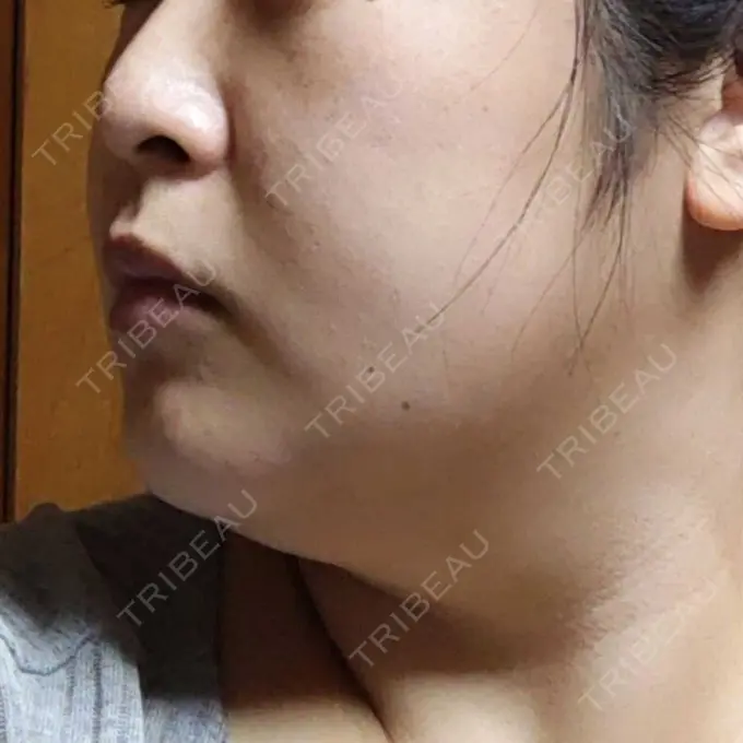 医療痩身（顔） 湘南美容クリニック 名古屋院 DAY 6 メイン用