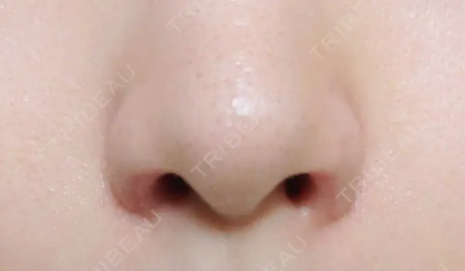 鼻孔縁挙上 シエルクリニック DAY 22 メイン用