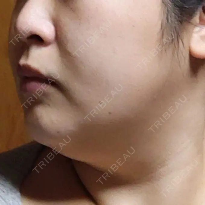 医療痩身（顔） 湘南美容クリニック 名古屋院 DAY 7 メイン用