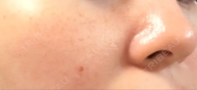 ほくろ・いぼ切除（肌） 吉祥寺アイビークリニック DAY 4 メイン用