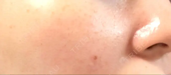 ほくろ・いぼ切除（肌） 吉祥寺アイビークリニック DAY 5 メイン用