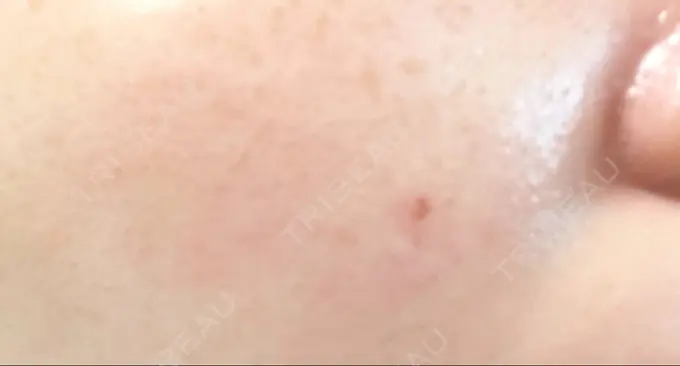 ほくろ・いぼ切除（肌） 吉祥寺アイビークリニック DAY 6 メイン用