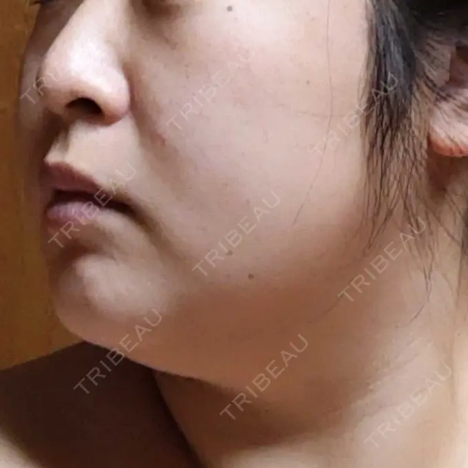 医療痩身（顔） 湘南美容クリニック 名古屋院 DAY 8 メイン用