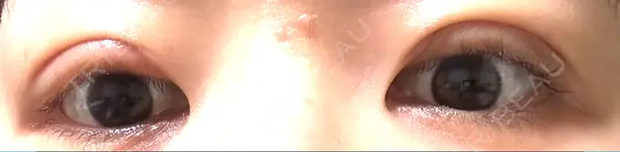 眼瞼下垂（切開） / 目元修正 札幌ル・トロワ ビューティクリニックVogue DAY 15 メイン用