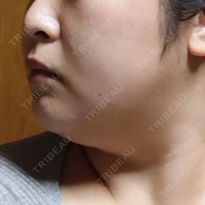 医療痩身（顔） 湘南美容クリニック 名古屋院 DAY 9 メイン用