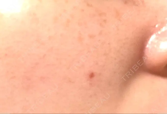 ほくろ・いぼ切除（肌） 吉祥寺アイビークリニック DAY 7 メイン用