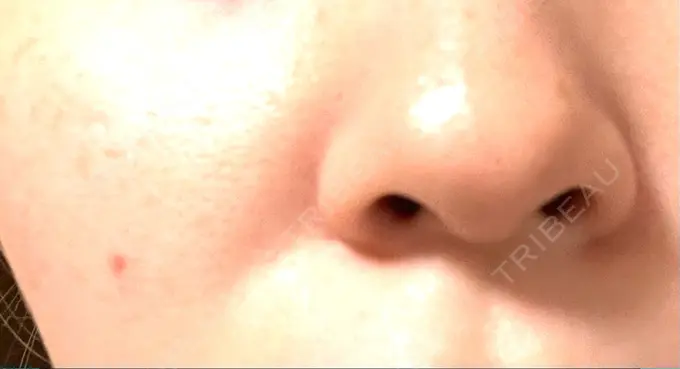 ほくろ・いぼ切除（肌） 吉祥寺アイビークリニック DAY 8 メイン用