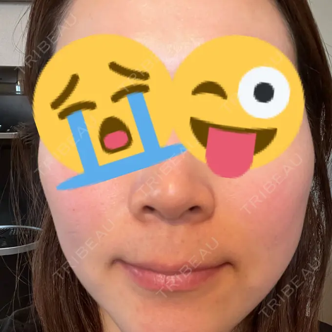 美肌レーザー Rosa Beauty Clinic AFTER メイン用