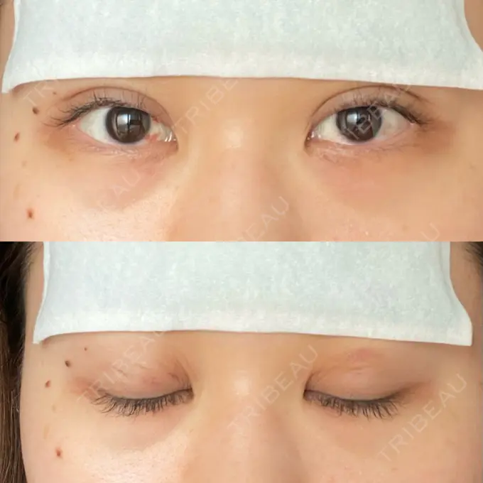 二重埋没 湘南美容クリニック 京都院 DAY 5 メイン用