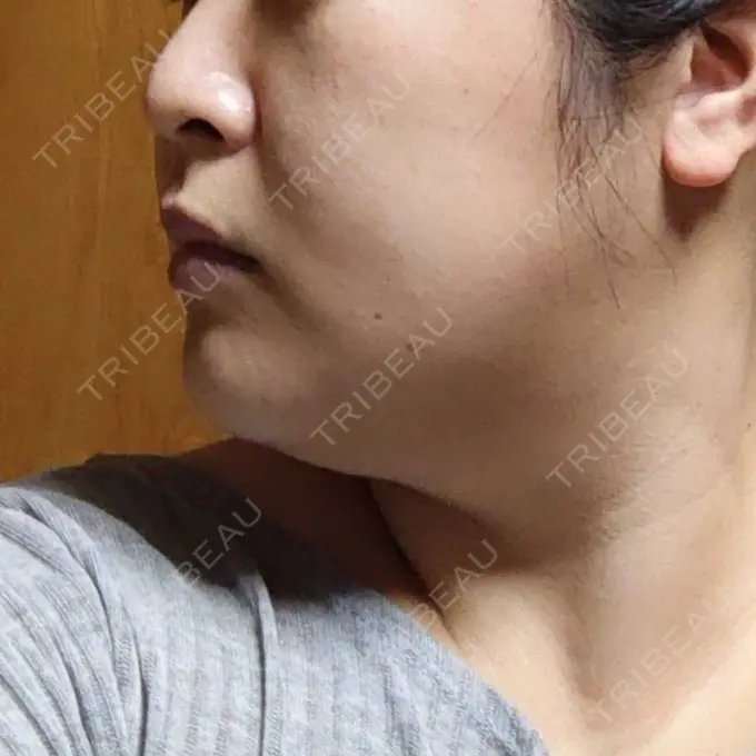 医療痩身（顔） 湘南美容クリニック 名古屋院 AFTER メイン用