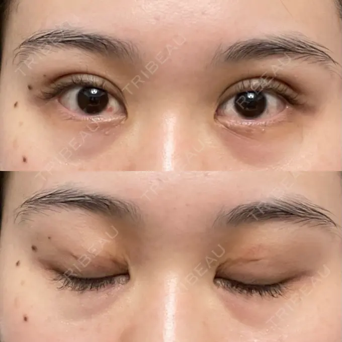 二重埋没 湘南美容クリニック 京都院 AFTER メイン用