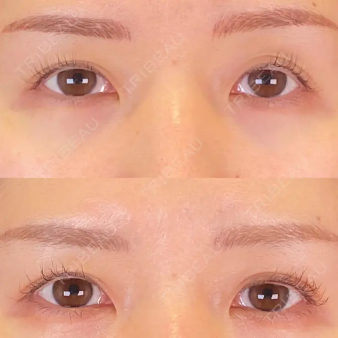 二重埋没 SOL CLINIC AFTER メイン用