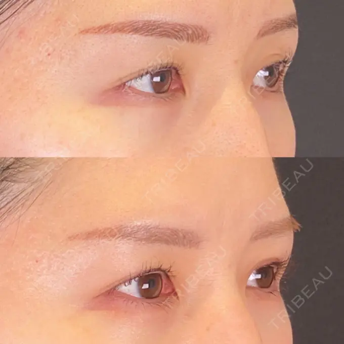 二重埋没 SOL CLINIC DAY 28 メイン用