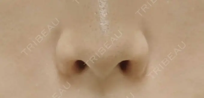 鼻孔縁挙上 シエルクリニック DAY 28 メイン用