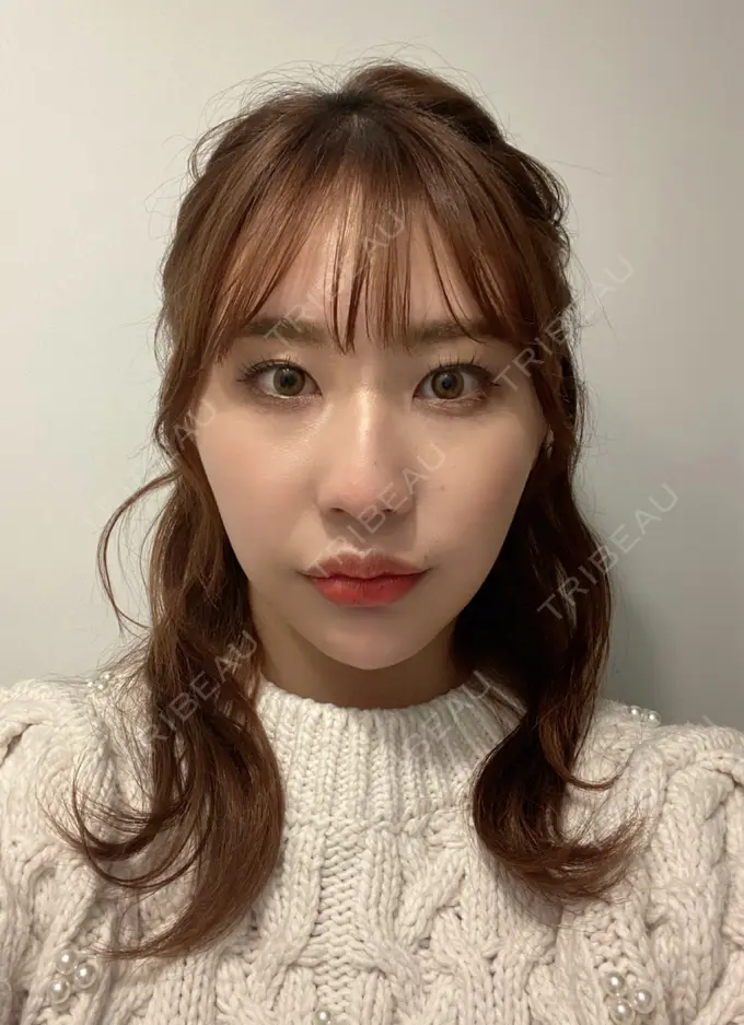 糸リフト / バッカルファット除去 / 脂肪吸引（顔） / ボトックス（あご） / ヒアルロン酸注入（あご） / ボトックス（エラ・小顔） WOM CLINIC GINZA （ワム クリニック ギンザ） DAY 365 メイン用