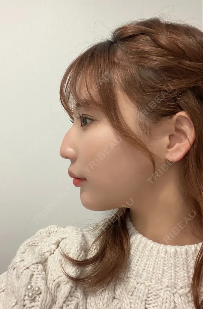 糸リフト / バッカルファット除去 / 脂肪吸引（顔） / ボトックス（あご） / ヒアルロン酸注入（あご） / ボトックス（エラ・小顔） WOM CLINIC GINZA （ワム クリニック ギンザ） DAY 365 メイン用