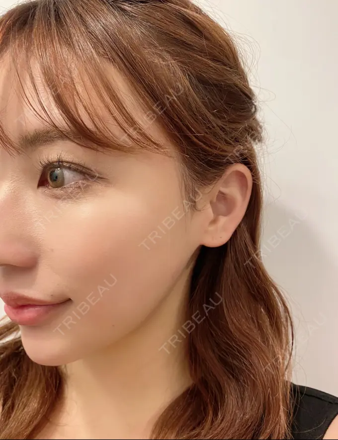 糸リフト / バッカルファット除去 / 脂肪吸引（顔） / ボトックス（あご） / ヒアルロン酸注入（あご） / ボトックス（エラ・小顔） WOM CLINIC GINZA （ワム クリニック ギンザ） DAY 365 メイン用