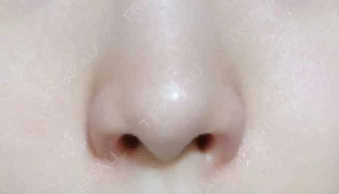 鼻孔縁挙上 シエルクリニック DAY 28 メイン用