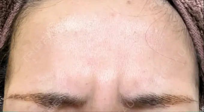 ボトックス（眉間） / ボトックス（額） / その他（鼻） TCB東京中央美容外科 郡山院 DAY 51 メイン用