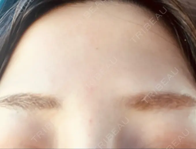 ボトックス（眉間） / ボトックス（額） / その他（鼻） TCB東京中央美容外科 郡山院 AFTER メイン用