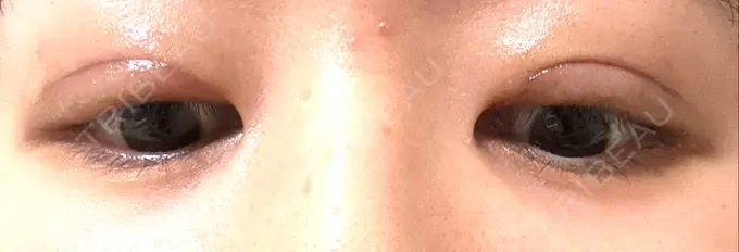 眼瞼下垂（切開） / 目元修正 札幌ル・トロワ ビューティクリニックVogue DAY 20 メイン用