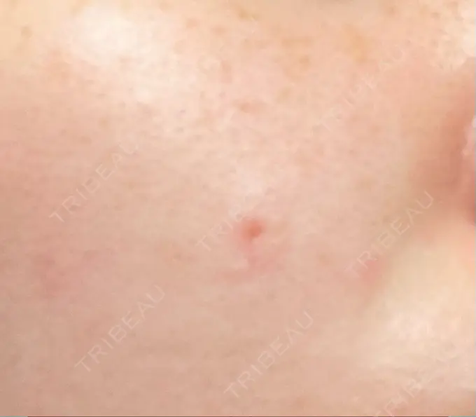 ほくろ・いぼ切除（肌） 吉祥寺アイビークリニック DAY 9 メイン用