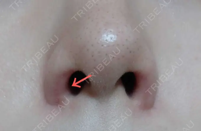 鼻孔縁挙上 シエルクリニック DAY 31 メイン用