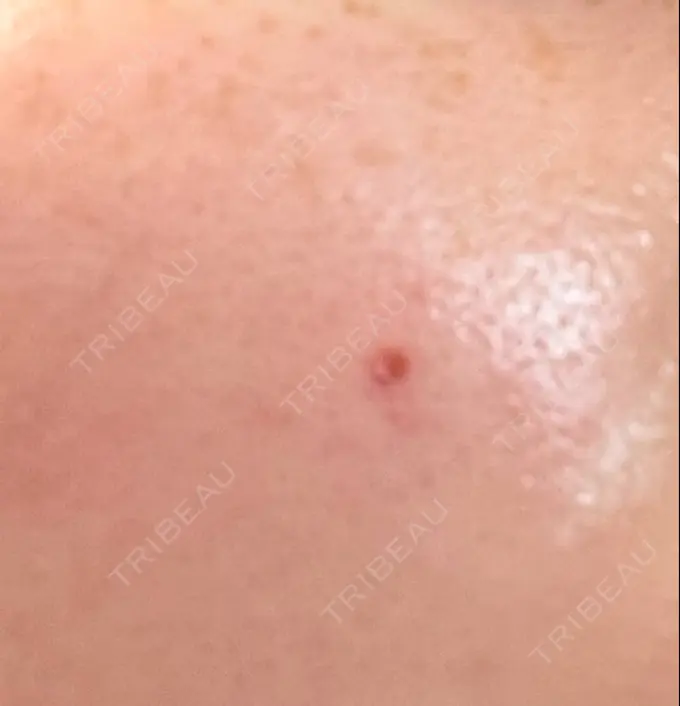 ほくろ・いぼ切除（肌） 吉祥寺アイビークリニック AFTER メイン用