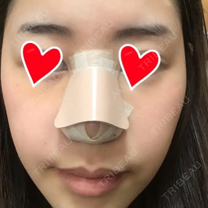 隆鼻術 / 鼻中隔延長（切開） / 軟骨移植 / 鼻修正 / 鼻孔縁下降 加藤クリニック 麻布東京院 DAY 5 メイン用