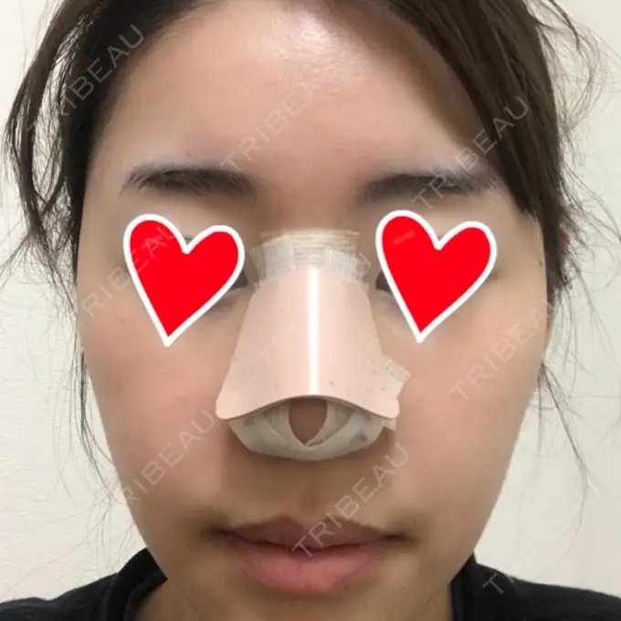 隆鼻術 / 鼻中隔延長（切開） / 軟骨移植 / 鼻修正 / 鼻孔縁下降 加藤クリニック 麻布東京院 DAY 6 メイン用